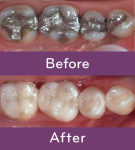 Before And After: Mercury Filling Replacement
