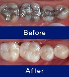 Mercury Filling Replacement: Before and After