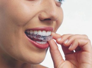 ccInvisalign